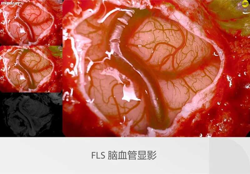  迈瑞全域荧光智能影像平台，探索精准外科未达之“镜” 新闻